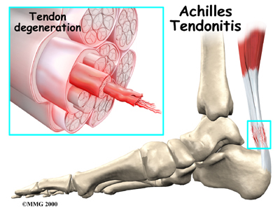 general tendonitis achilles ana03 1