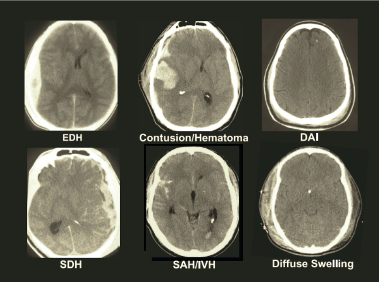 Types Of Brain Injuries - Health Bound Health Network