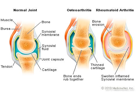 Arthritis: Cause and Prevention